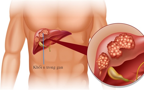 Cách phát hiện sớm ung thư gan