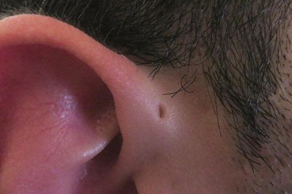 Lỗ nhỏ ở cạnh tai là gì?