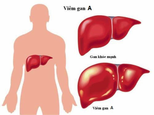 Nhận biết bệnh viêm gan A