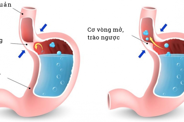 Trào ngược dạ dày có gây hôi miệng?