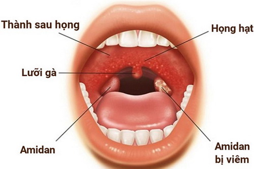 Vì sao bị áp-xe quanh amidan?