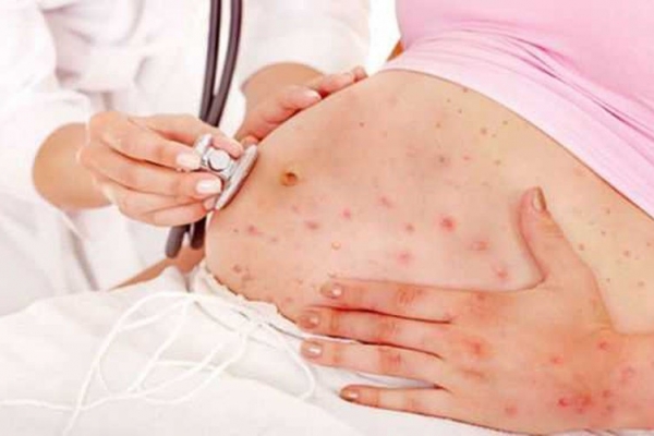 Mắc sốt xuất huyết khi mang thai có nguy hiểm?
