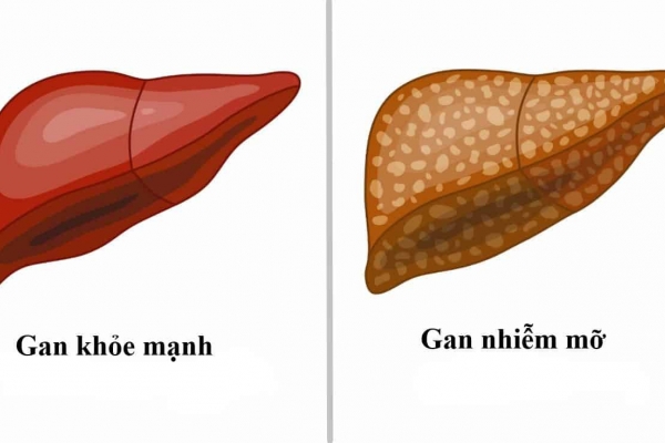 Phòng gan nhiễm mỡ, cách gì?