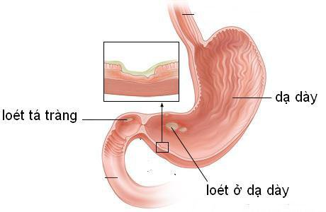 Người viêm loét dạ dày - tá tràng nên ăn thế nào?