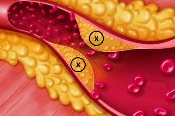 Dấu hiệu rối loạn lipid máu