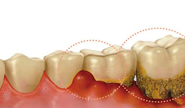 Viêm lợi có gây biến chứng?