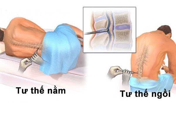 Nguy cơ khi chọc dò tủy sống