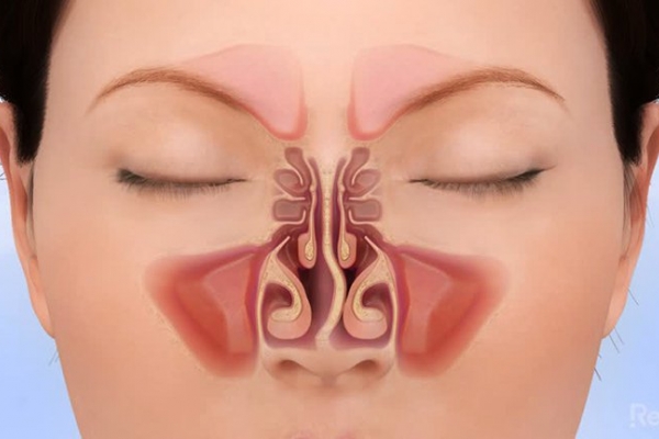 Dấu hiệu vẹo vách ngăn mũi
