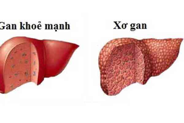 Dấu hiệu nhận biết xơ gan