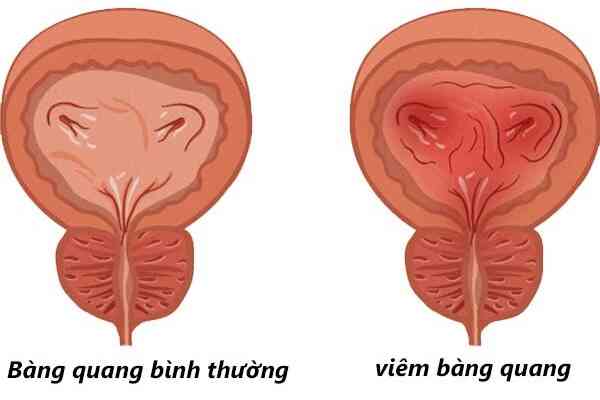 Viêm bàng quang tái phát có nguy cơ gì?