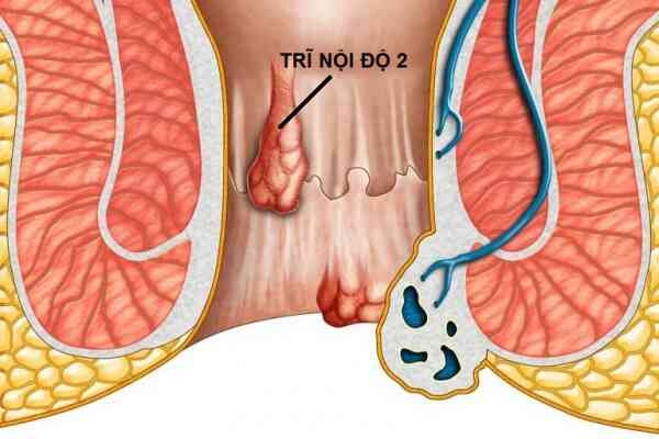 Trĩ nội, khi nào cần phẫu thuật?