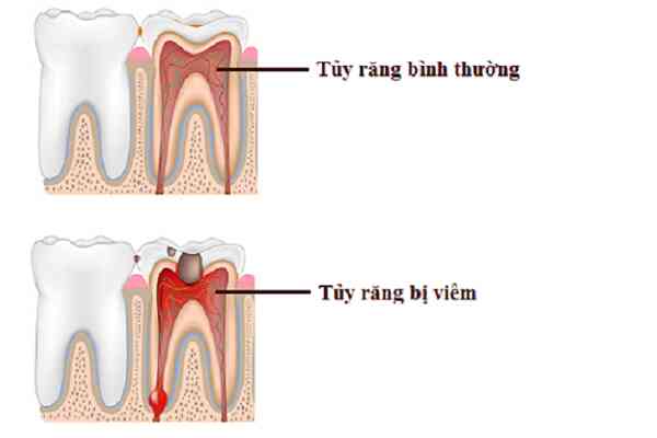 Viêm tủy răng do đâu?