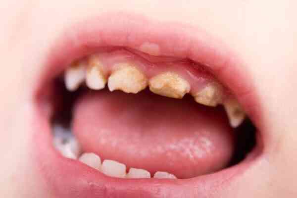 Vì sao răng sữa bị sâu?