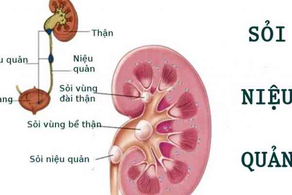 Sỏi niệu quản có nguy hiểm?
