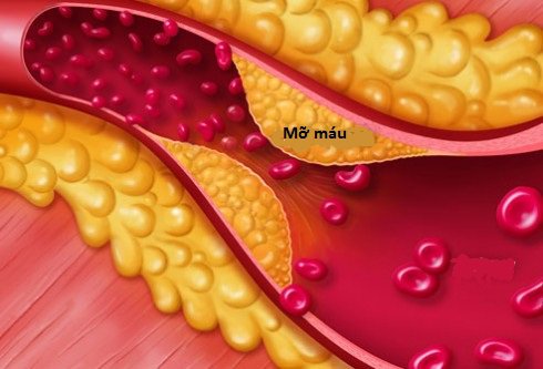 Rối loạn mỡ máu và biến chứng