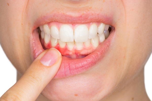 Viêm lợi có gây rụng răng?