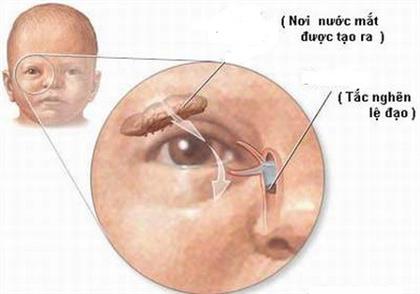 Tắc lệ đạo, do đâu?