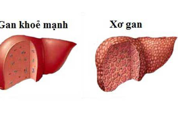 Xơ gan và chảy máu thực quản