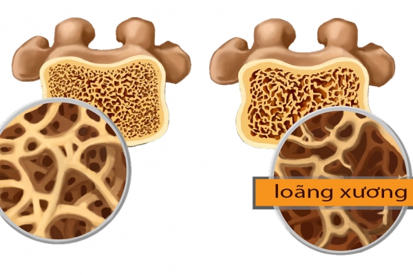 Cách phòng ngừa loãng xương