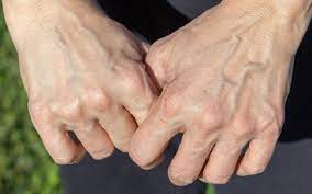 Giãn tĩnh mạch bàn tay có khó trị?