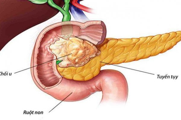 Các yếu tố làm tăng nguy cơ ung thư tụy