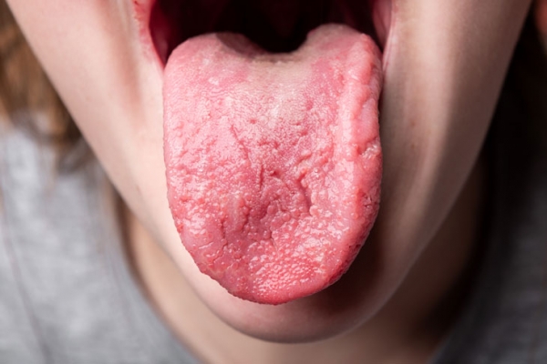 Vết lạ trên lưỡi - Viêm lưỡi hay ung thư?