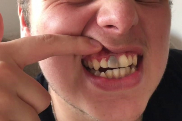 Răng đổi mầu xám đen là bị sao?