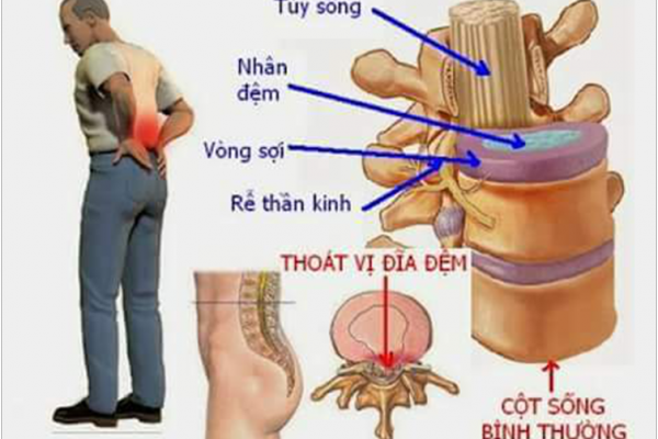 Thoát vị đĩa đệm cột sống thắt lưng chữa thế nào?