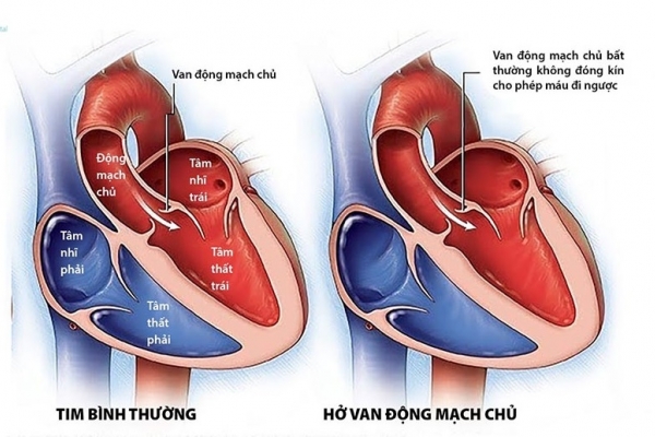 Hở van động mạch chủ có cần mổ ?